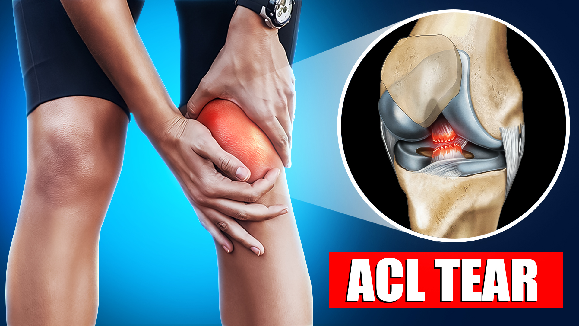 ACL 1