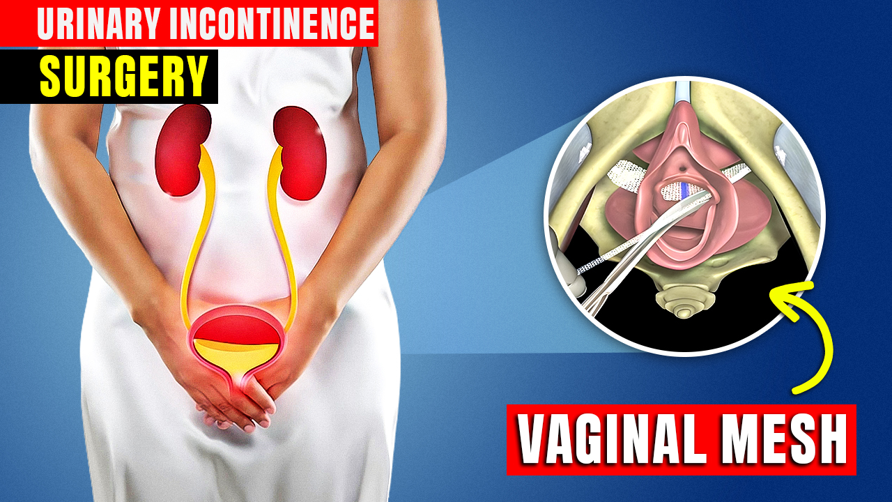 Urinary-Sling-Procedure-C